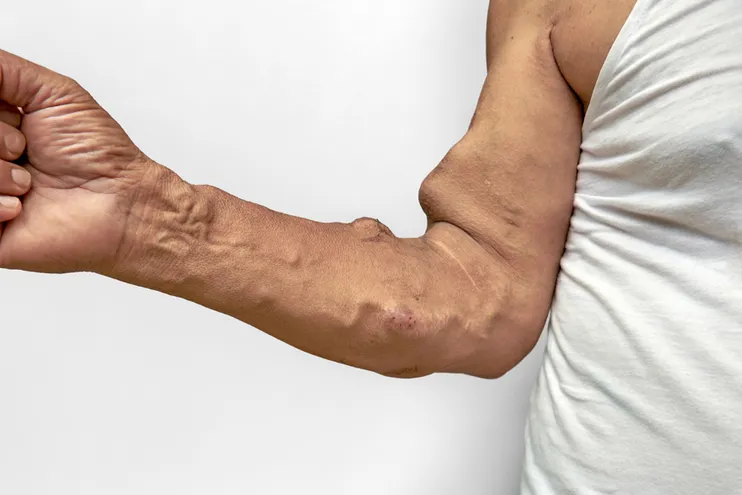 Síndrome de roubo de fluxo