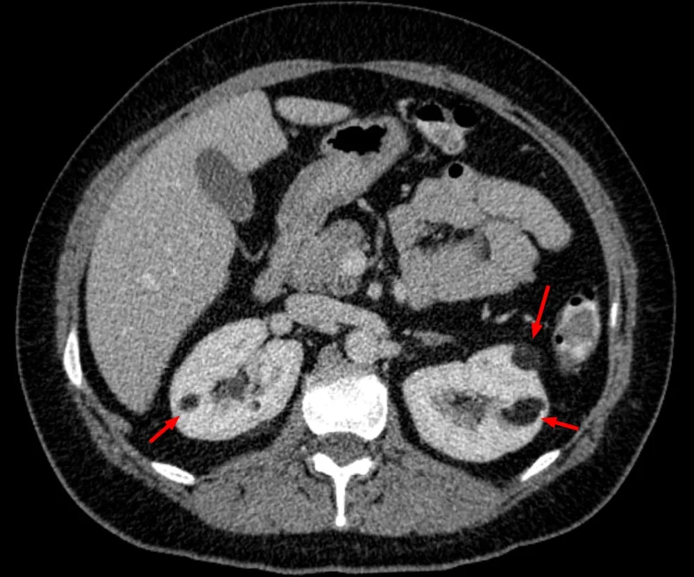 Angiomiolipoma renal, quando pensar em Esclerose Tuberosa?