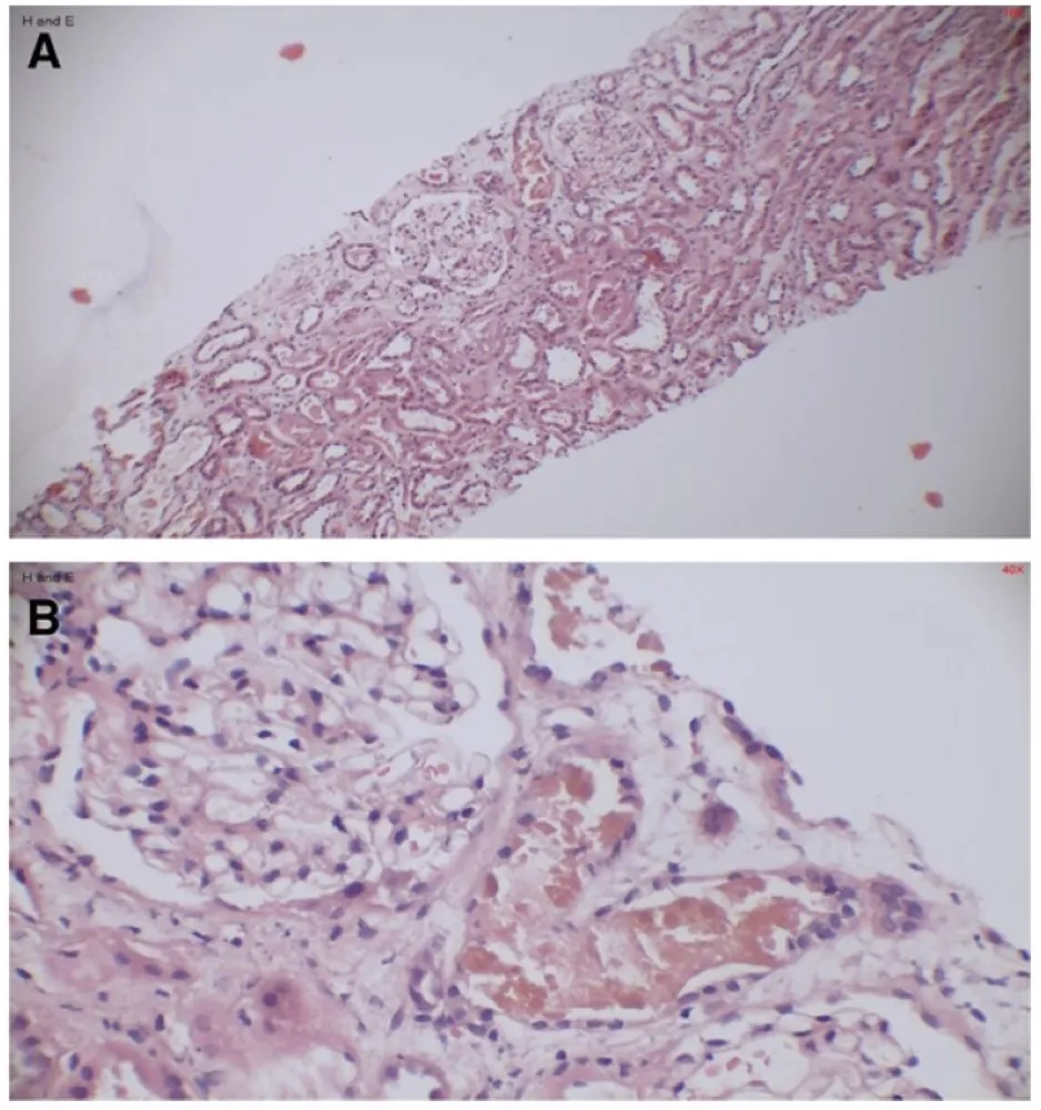 Icterícia, hepatite e disfunção renal