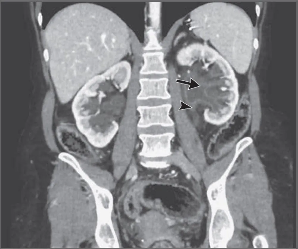 ITU recorrente e deficiência de vitamina A, como assim?