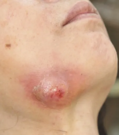 Osteonecrose de mandíbula relacionada a medicamentos