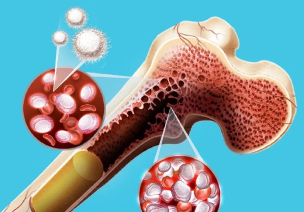 Rim no mieloma: o diagnóstico preciso faz a diferença!