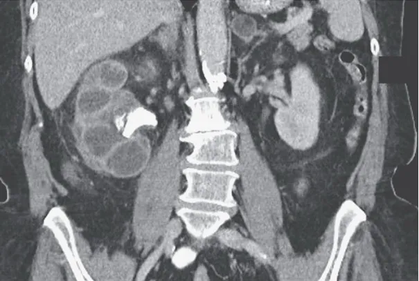 Sinal da “Pata de Urso”