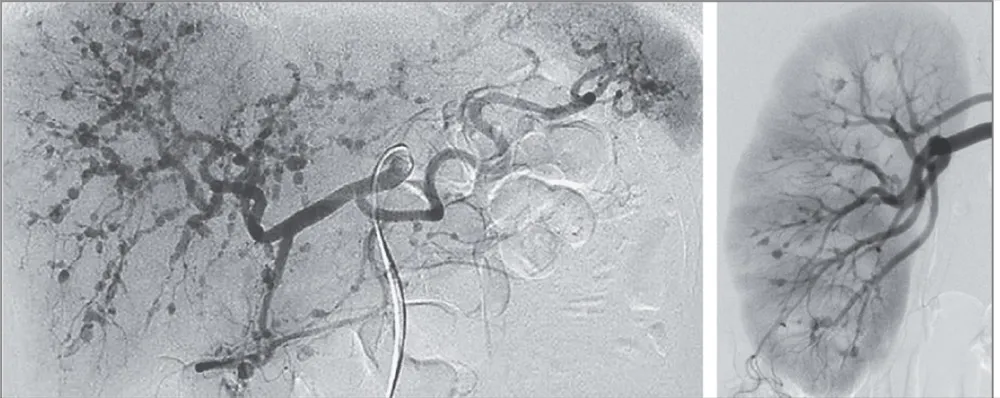 Qual seria essa vasculite?
