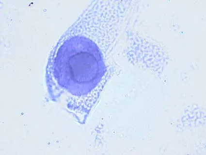 BK vírus no Transplante Renal: Quando Reduzir a Imunossupressão?