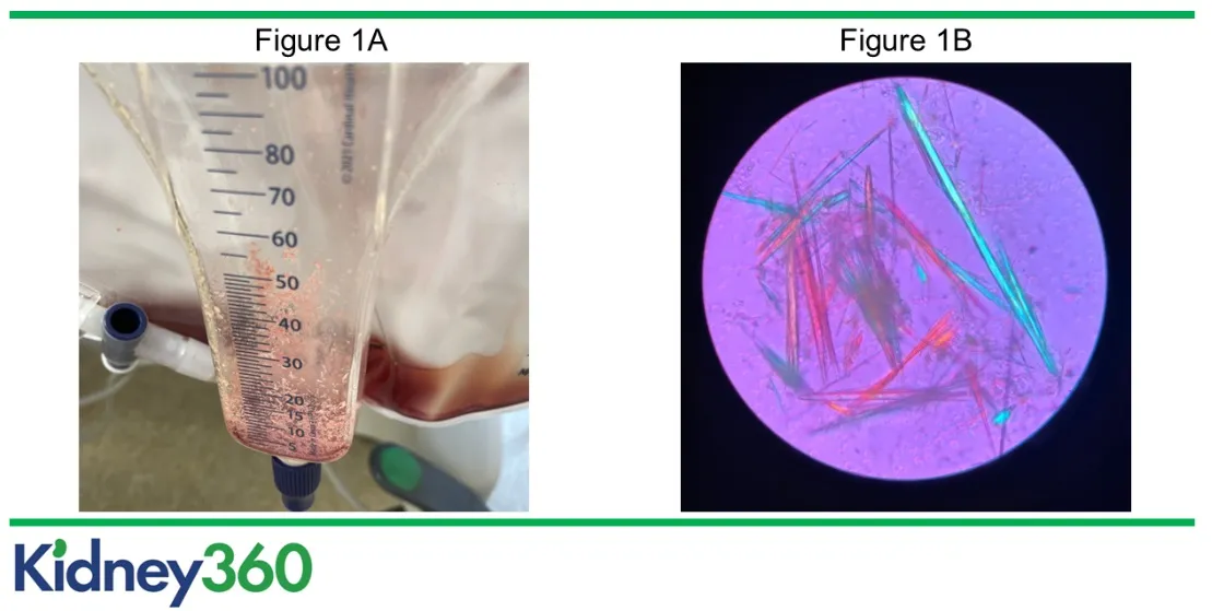 Desafio diagnóstico: IRA em paciente em tratamento para Encefalite Herpética