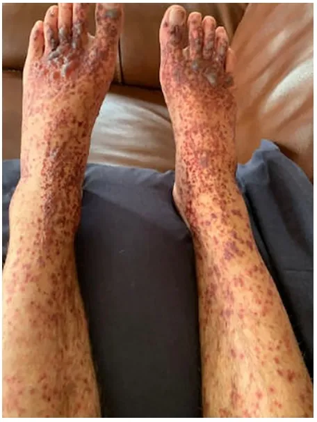 Caso clínico: Nefropatia IgA com piora de função após vacina