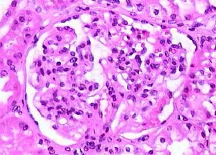 Nefropatia por IgA e proteinúria persistente: o que fazer quando o RASi e o iSGLT2 não bastam?