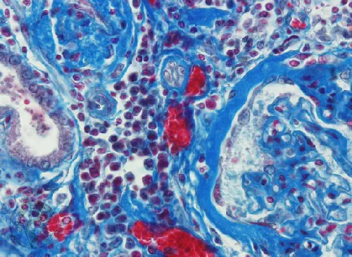 Calculadora para NIA: uma ajuda adicional para indicar biópsia renal!