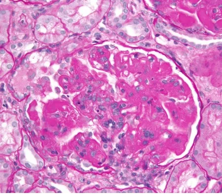 Desmame de imunossupressores na Nefrite Lúpica