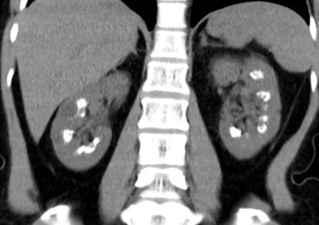 Nefrocalcinose: entendendo a doença e padronizando a abordagem