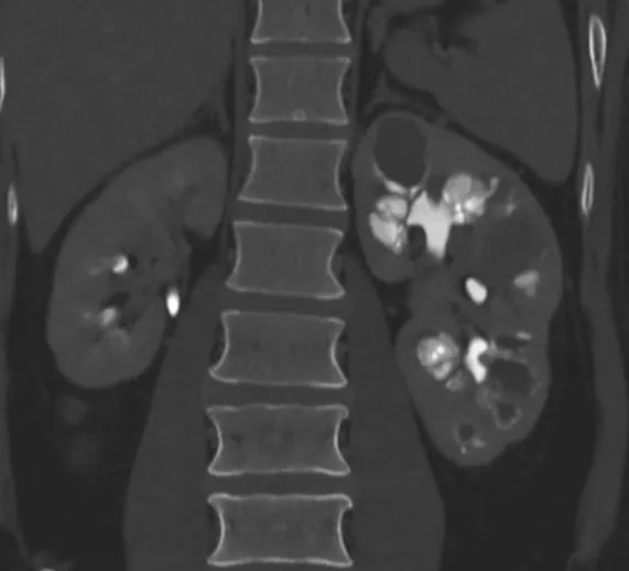 Hematúria e anormalidades em tomografia