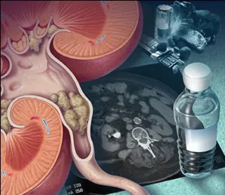 Em quem realizar o estudo metabólico dos cálculos renais?