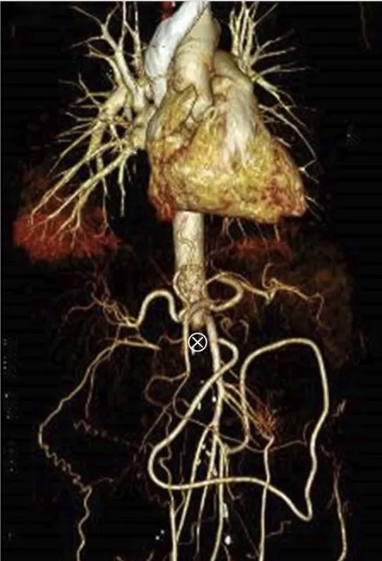 Paciente com dor lombar evoluindo com IRA e anúria