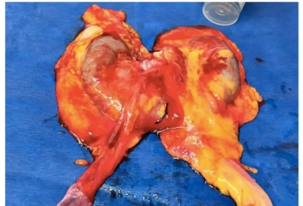 Rim em ferradura para transplante renal?