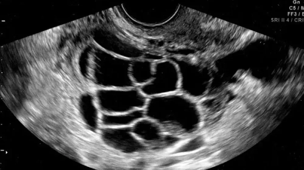 Síndrome de Hiperestimulação Ovariana causando IRA