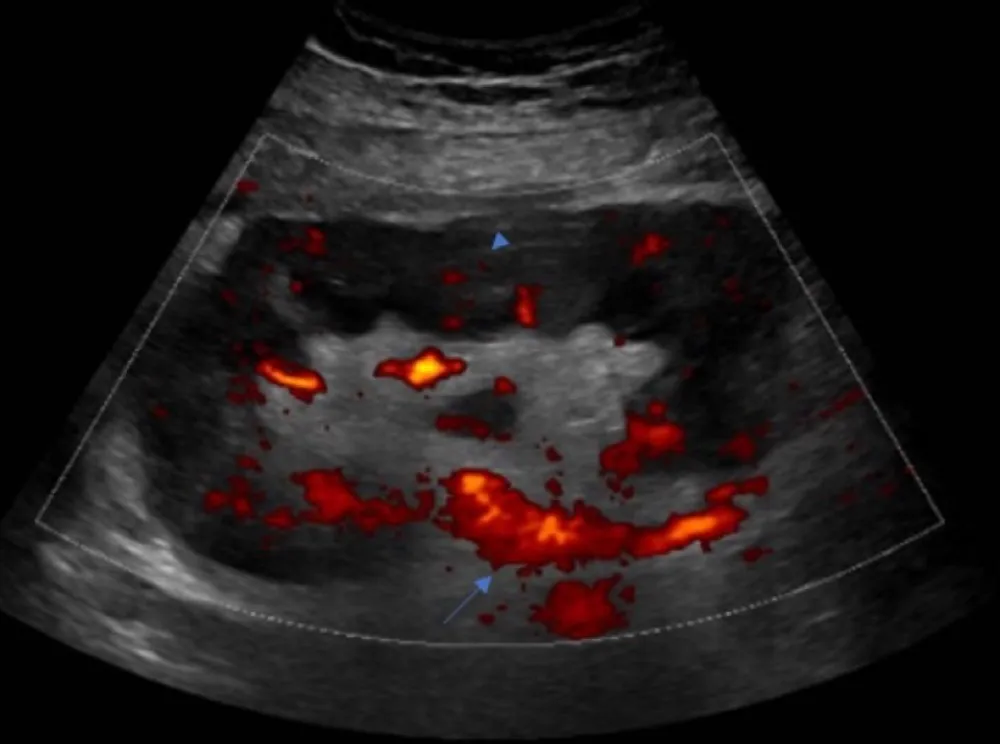Uma causa incomum de isquemia do enxerto renal!