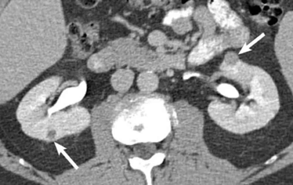 Múltiplos tumores renais