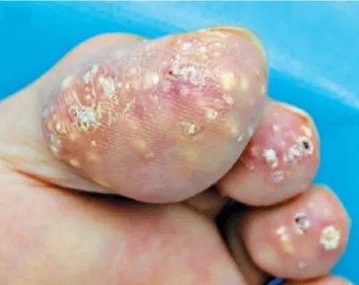 IRA causada por Vitamina C