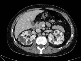 iSGLT2 na Doença Policística Renal: Promessa real ou ilusão terapêutica?