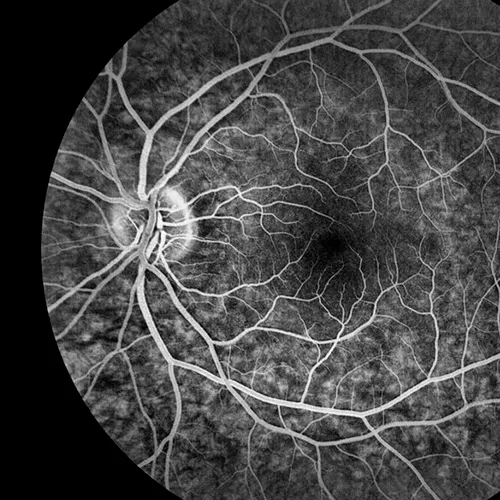 Angiografia com Fluoresceína em Pacientes com Doença Renal Crônica – É Seguro?