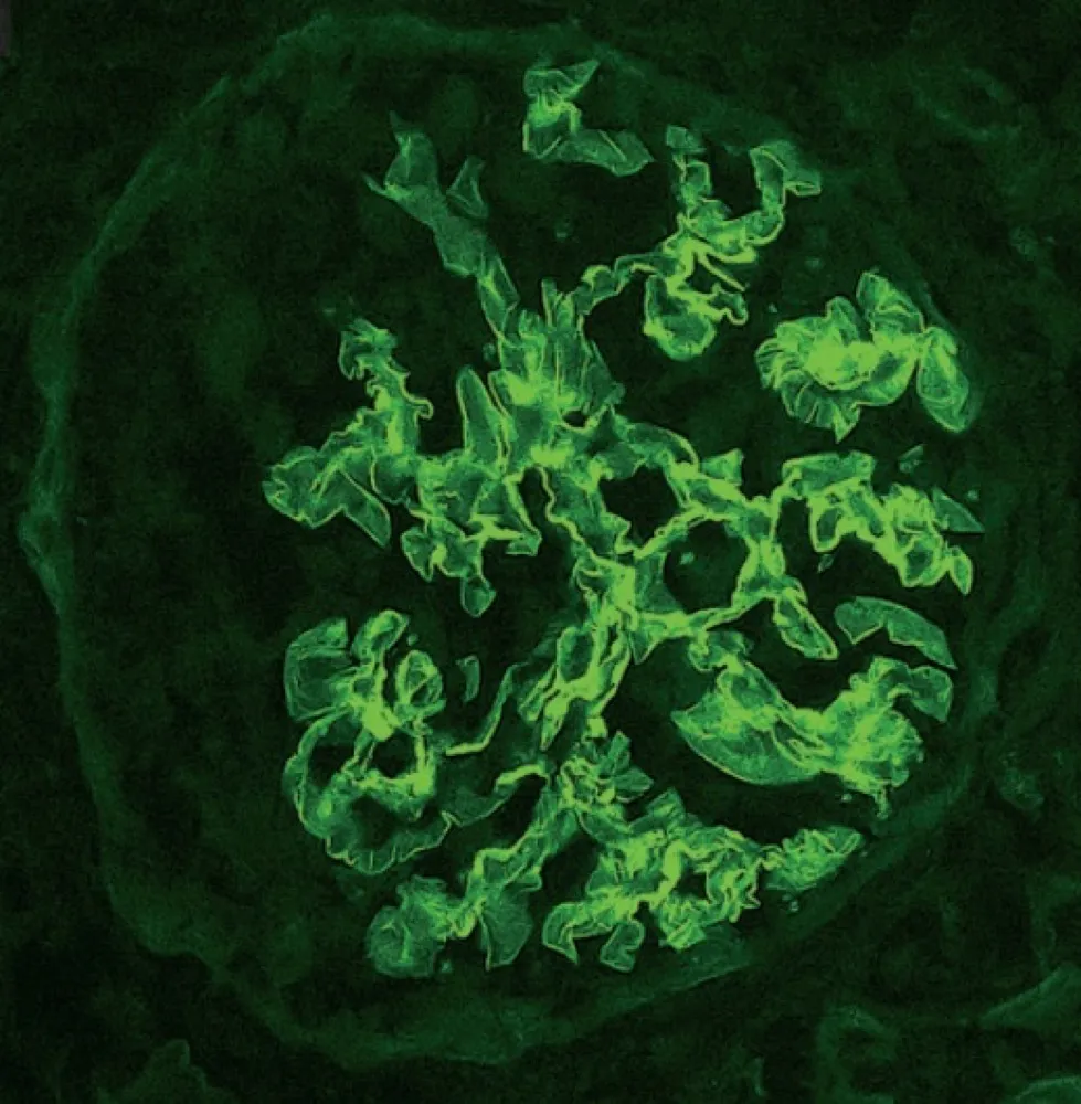 Idoso com GNRP, qual seria sua principal hipótese diagnóstica? 
