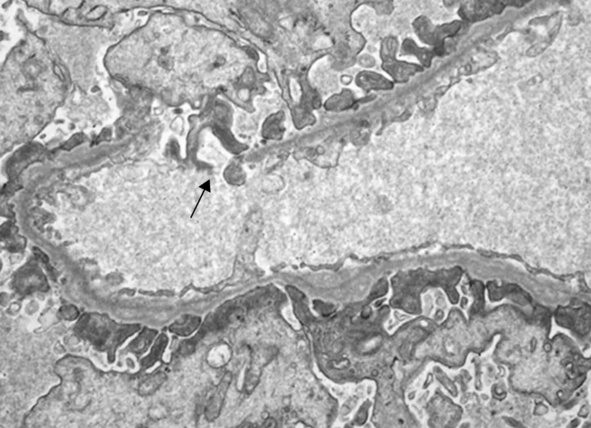 Seguimento clínico de familiares com síndrome de Alport 