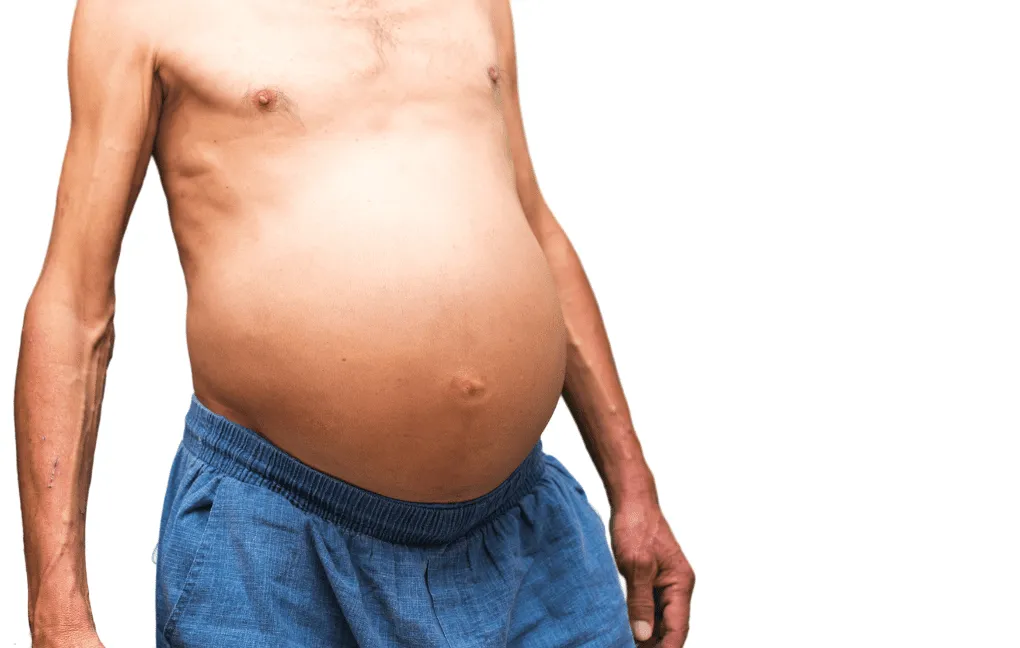 Hepatorrenal: o que o nefrologista precisa saber sobre o tratamento da síndrome hepatorrenal aguda