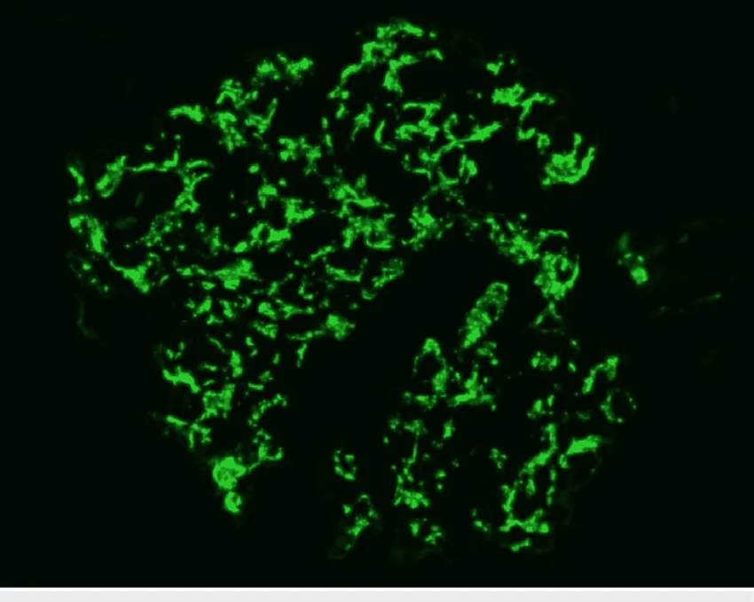 Hematúria e Proteinúria: quando o erro se repete…
