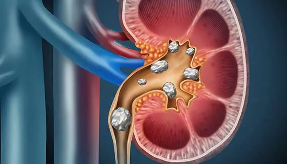Diuréticos tiazídicos na litíase renal: quanto maior a dose, maior o benefício!