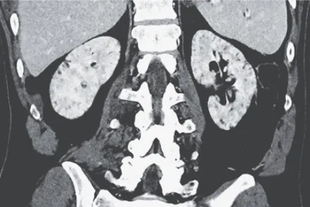 Múltiplos cistos renais pequenos, qual a etiologia?