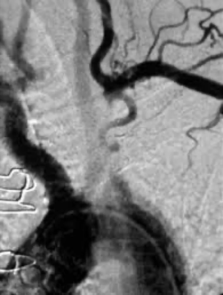 Caso Clínico: Complicações Cardiovasculares Relacionadas à FAV em Paciente em Hemodiálise