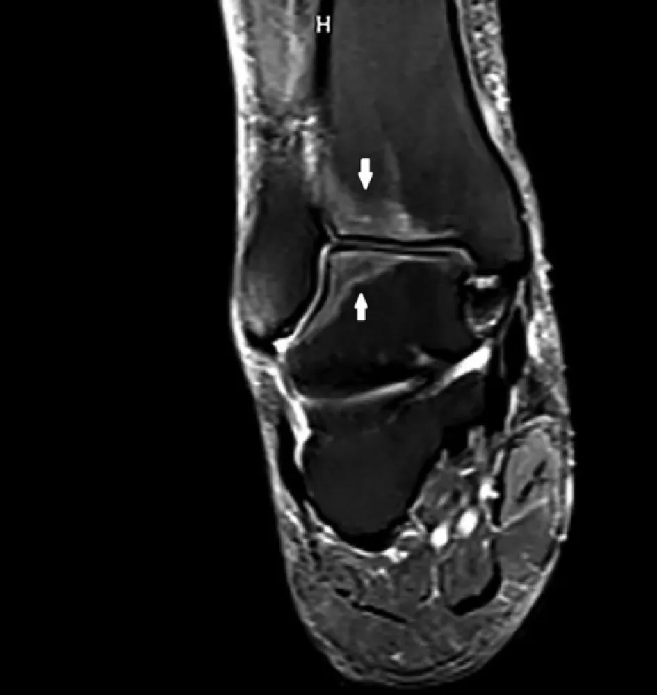 Dores em membros inferiores em um transplantado renal