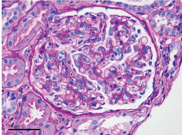 Uma causa incomum de hematúria glomerular intermitente!