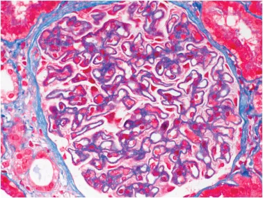 Será que essa Glomerulopatia não é paraneoplásica?
