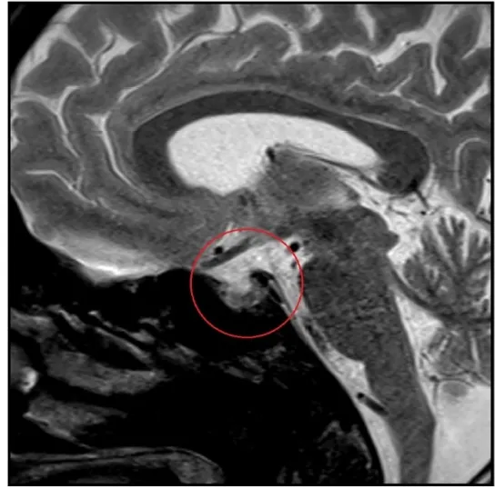 Hipotensão Durante Hemodiálise: uma etiologia rara que devemos lembrar!