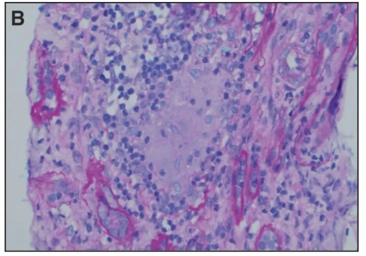Síndrome de reconstituição imune e disfunção renal no HIV
