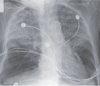 Atenção ao uso prolongado de Nitrofurantoína na ITU de repetição!