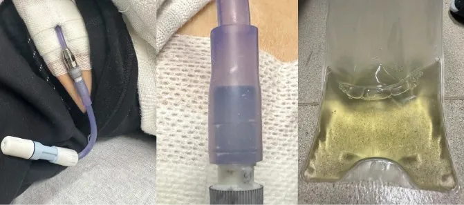 Cateter de Diálise Peritoneal Roxo: Diagnóstico e Aprendizados do Caso