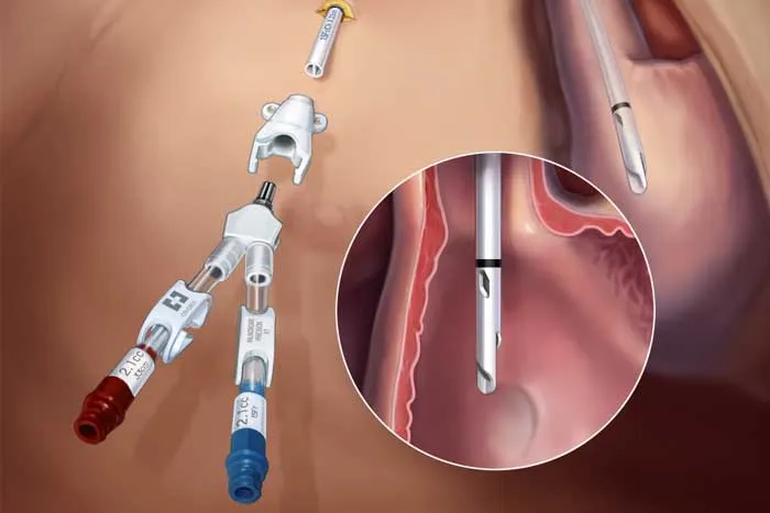 Trombose de Cateter de Diálise ou Trombose da Veia Jugular? Como Diferenciar e Tratar?