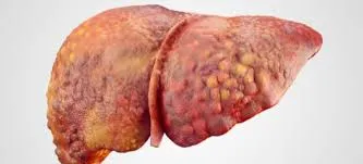 O Manejo da Terapia de Substituição Renal em Pacientes com IRA e Cirrose: Como eu trato
