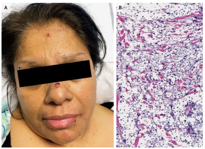 Cefaleia e lesões cutâneas em uma transplantada renal