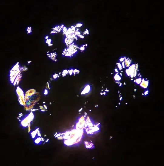 IRA sem etiologia, importância da biópsia renal! (caso clínico)