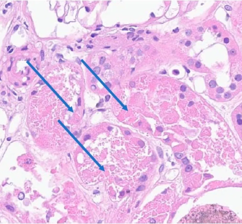 Proteinúria (sem albuminúria) e piora de função renal