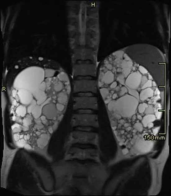 Obesidade na Doença Renal Policística: outras estretégias para proteção renal