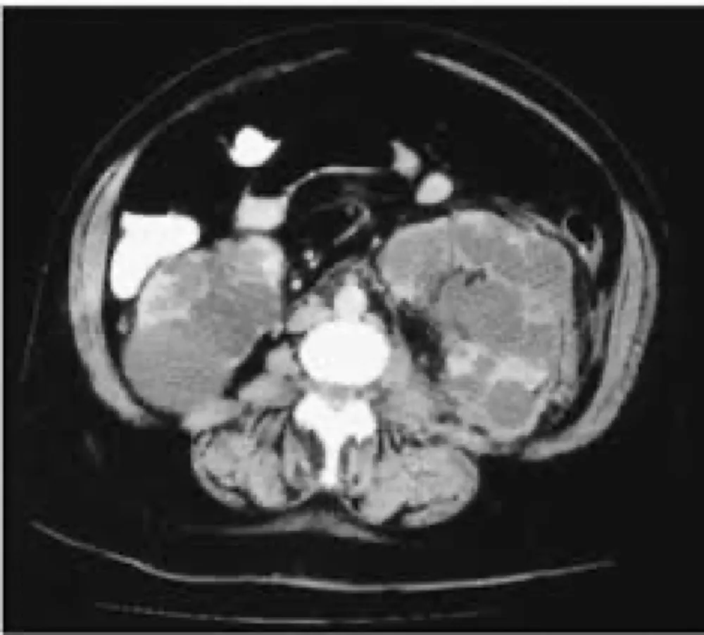 DRPAD: por que a gravidade da doença varia tanto dentro da família?