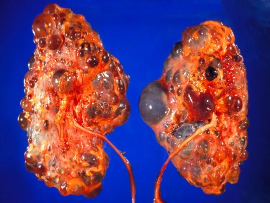 Doenças cardiovasculares na DRPAD: o que precisamos saber?