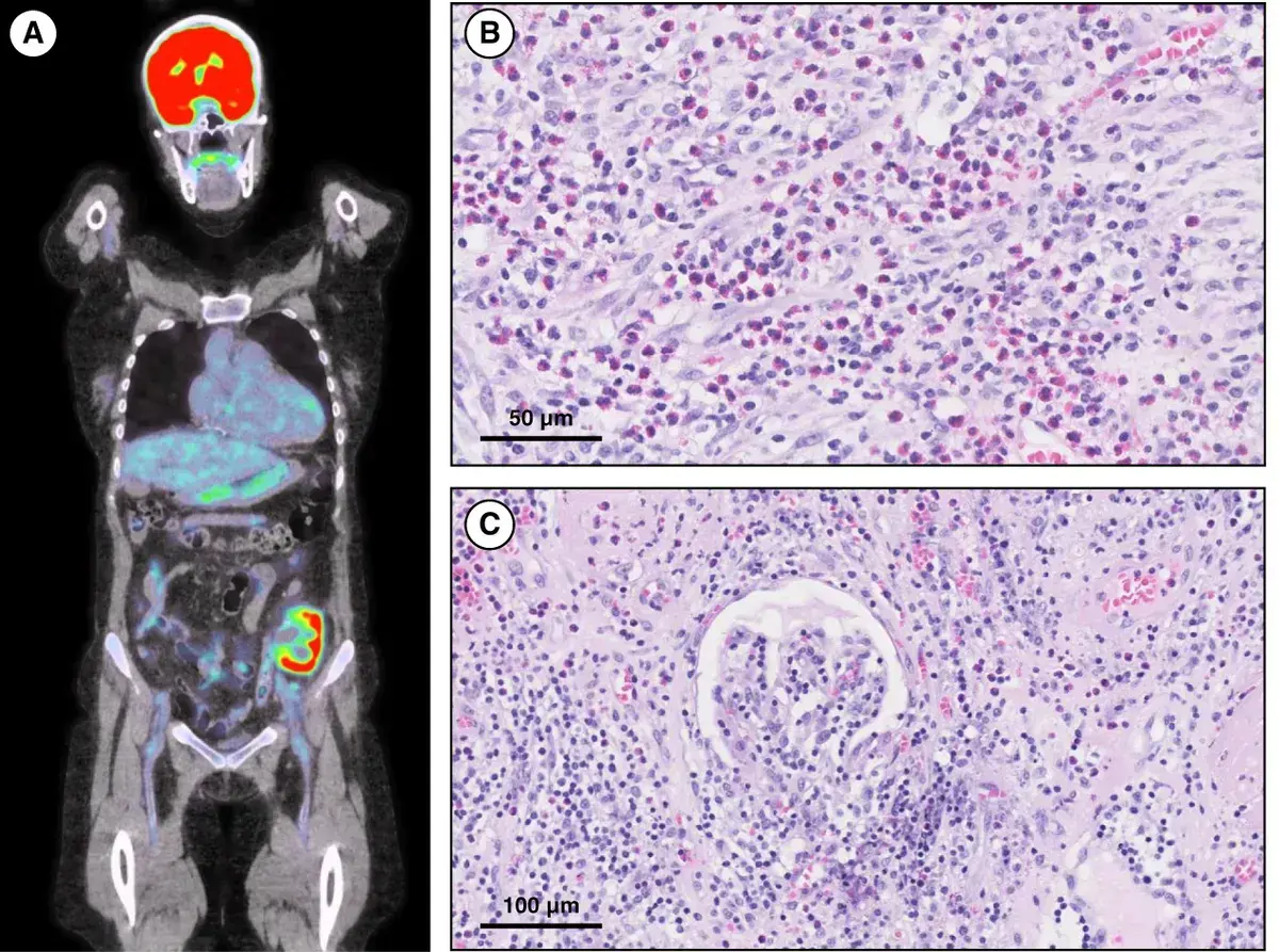 Rejeição de enxerto e eosinofilia!