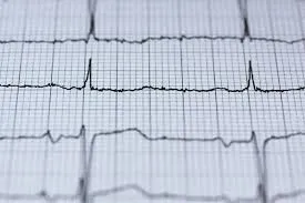 FA e Anticoagulação na Diálise