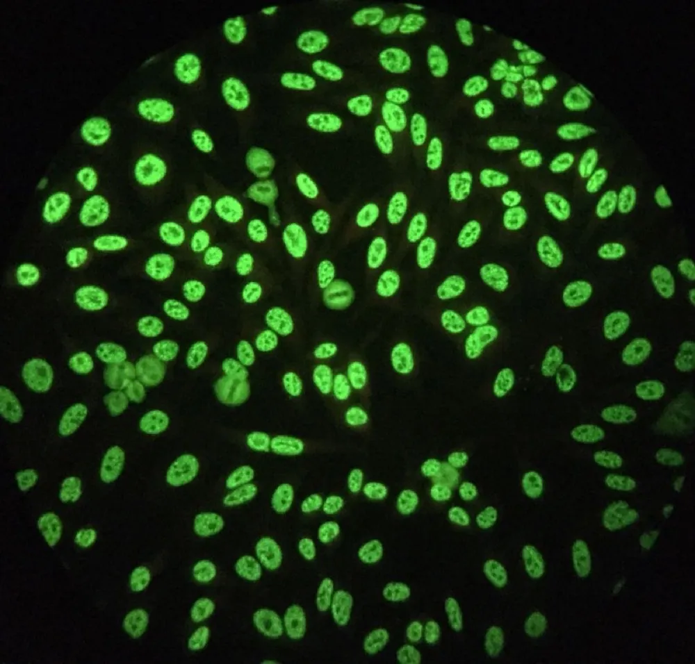Interpretação dos Anticorpos Antinucleares (FAN) para Nefrologistas
